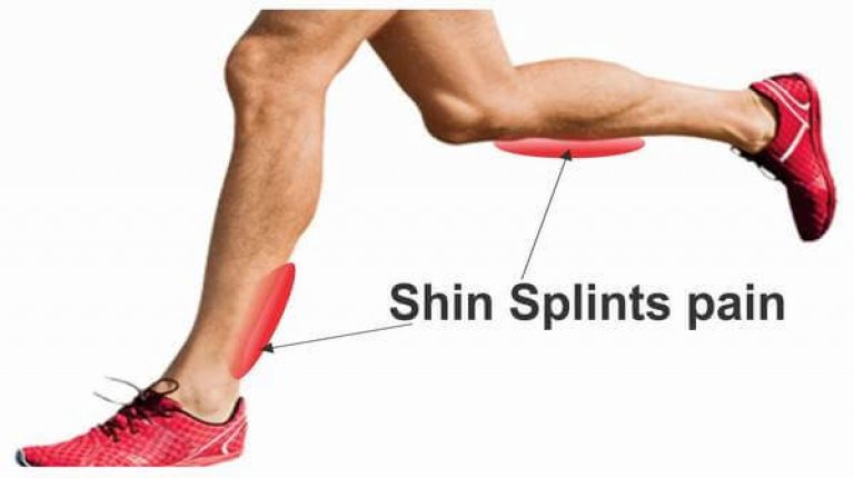 can a new mattress cause shin splints