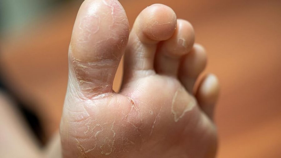 Why Do My Feet Itch At Night 8 Common Causes WalkJogRun