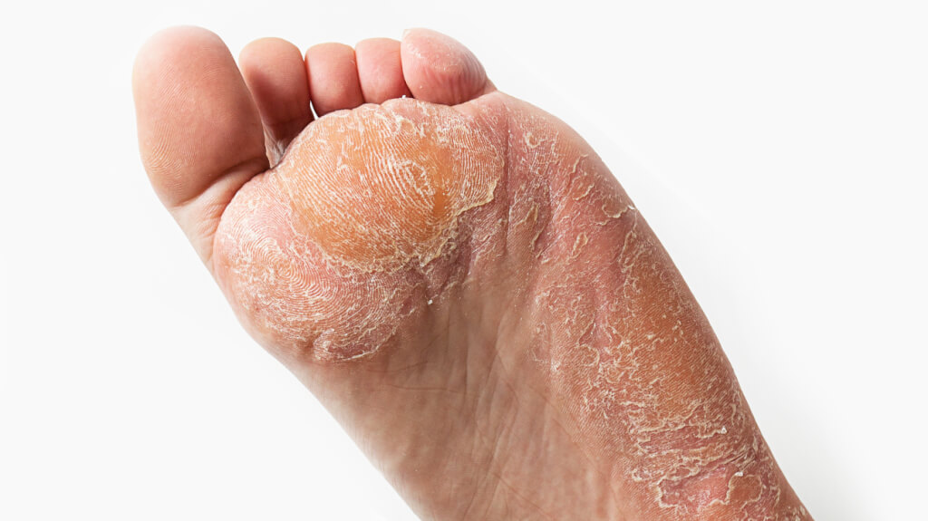 How To Get Rid Of Hard Skin On Feet Quick WalkJogRun